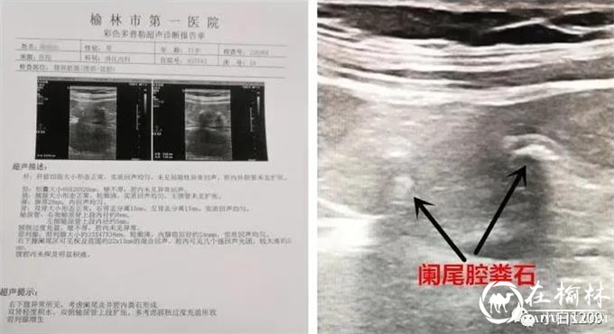 榆林市首例内镜逆行阑尾炎治疗术在榆林市第一医院绥德院区开展