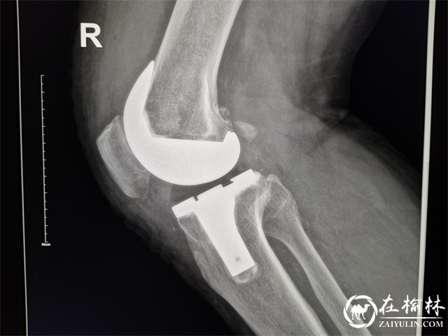省钱又方便，米脂县医院开展全膝关节置换术