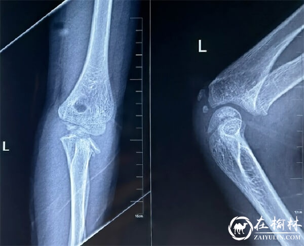 榆林二院骨科医院小儿骨折微创治疗再获新突破