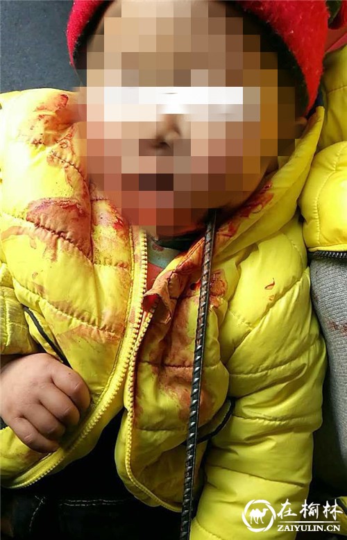 大年初二 商洛两岁男童玩耍出意外 钢筋穿脑插入