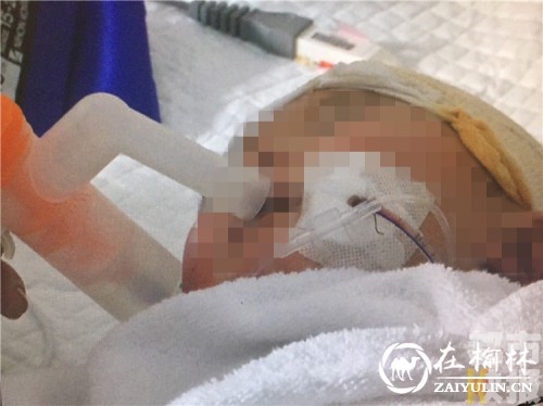 大年初二 商洛两岁男童玩耍出意外 钢筋穿脑插入