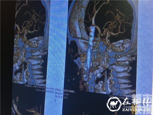 大年初二 商洛两岁男童玩耍出意外 钢筋穿脑插入